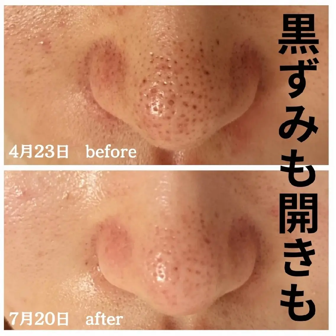 毛穴洗浄&マッサージ+高濃度美容液導入 60分 ¥3,300オフの写真