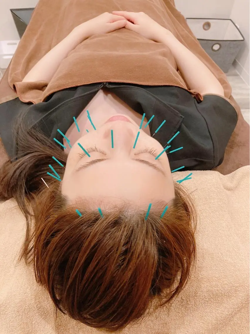 ご新規様限定🌸当店人気No.1 美容鍼の写真