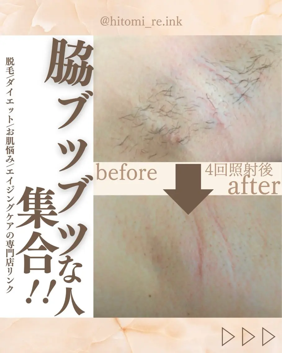 脱毛人気部位No. 1脇脱毛の写真
