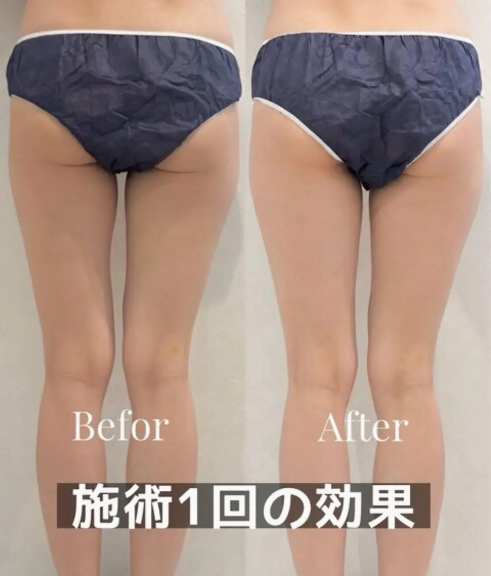 【美尻・美姿勢】ヒップアップ美脚効果スタイルUP×韓国式小顔コルギ110分の写真