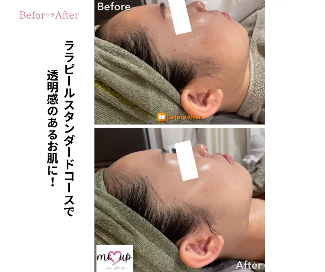 エステ Meupニキビ専門店 背中/ハーブ/肌管理のその他イメージ
