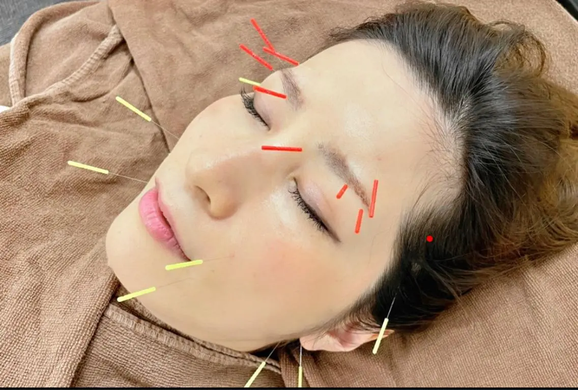 ハリウッド美容鍼灸®︎の写真
