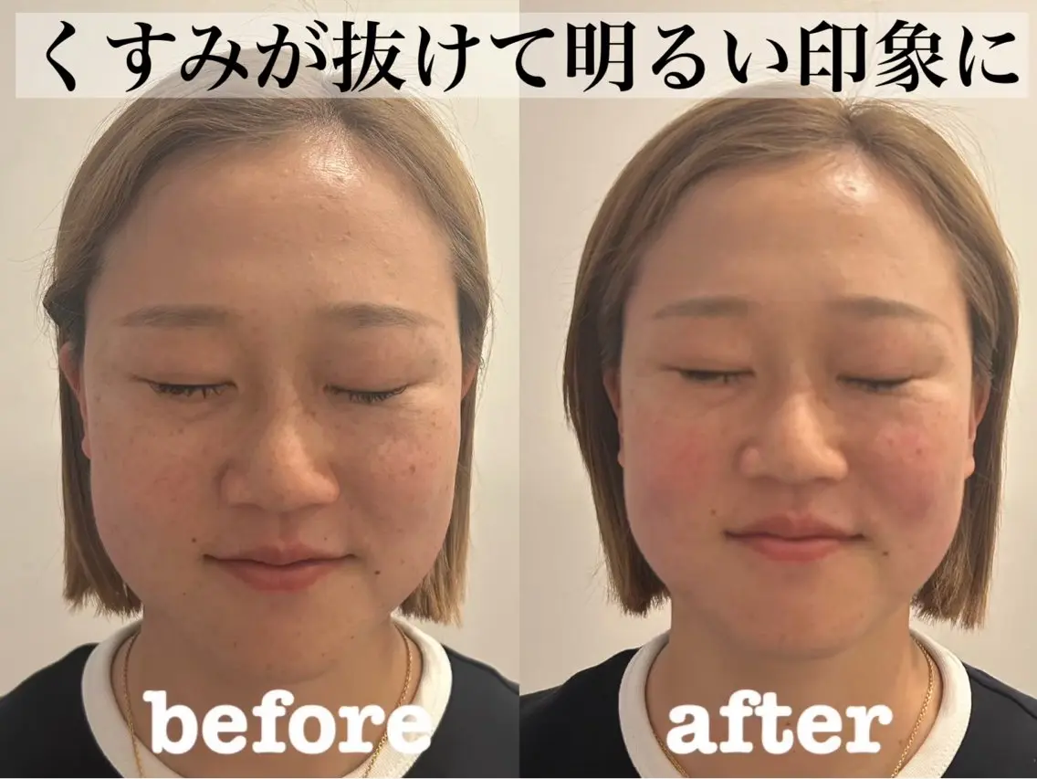 エステ リラク 大阪上本町 肌質改善×美容鍼ゆいのエステ・リラクイメージ