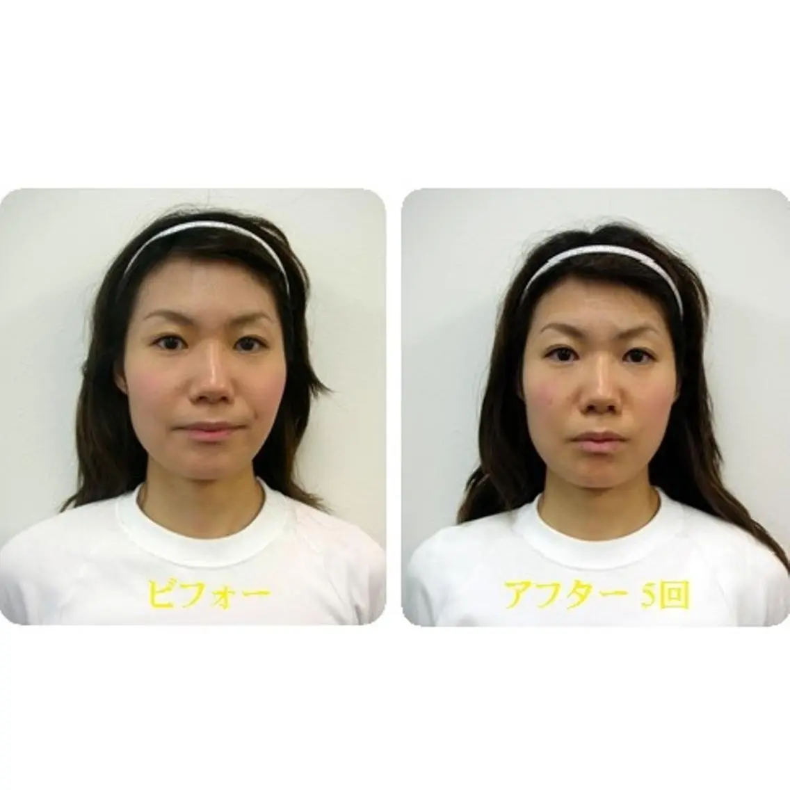 学割U24 【顔の歪み】非対称な下顎,エラ,頬の専門矯正/上級MAXコース￥7,800の写真