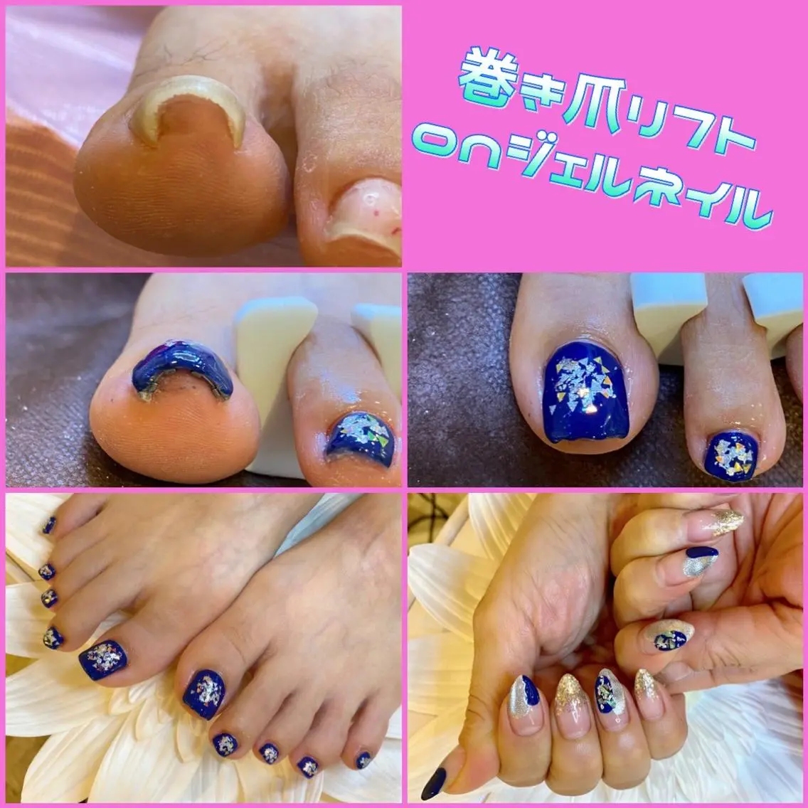 ネイル フットネイル 持ち込み 夏ネイル ♢ME2ROOM♢ #巻き爪#リラクのネイルデザイン