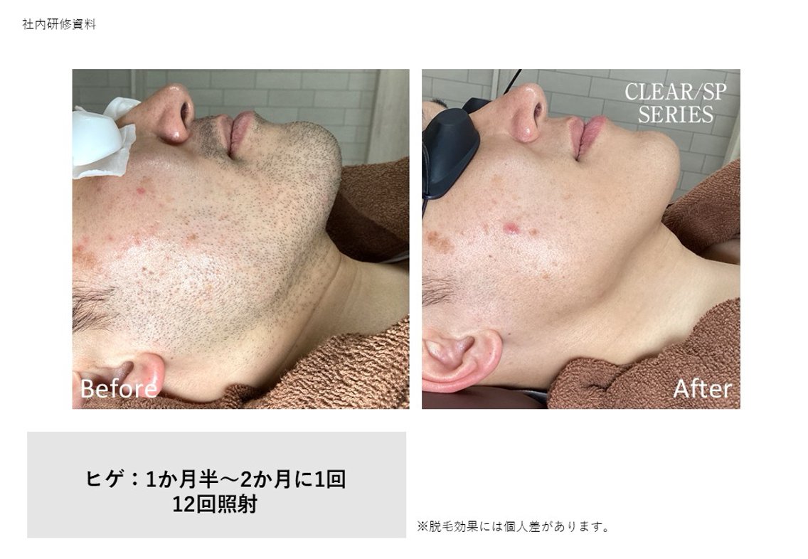 メンズ👑ヒゲ脱毛¥3000の写真