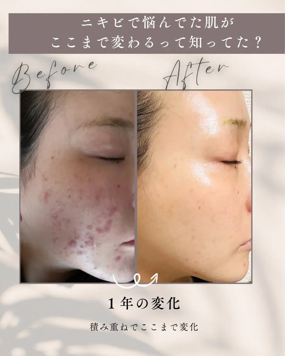 肌分析×毛穴 ツヤ肌エステTomiのエステ・リラクイメージ