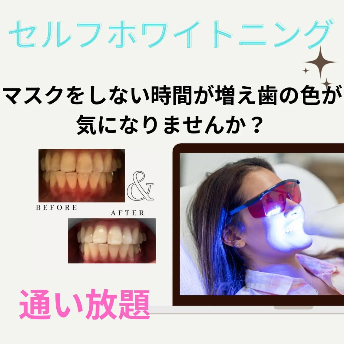 【30日間!通い放題】★《 セルフホワイトニング!染みない★効果重視!の写真
