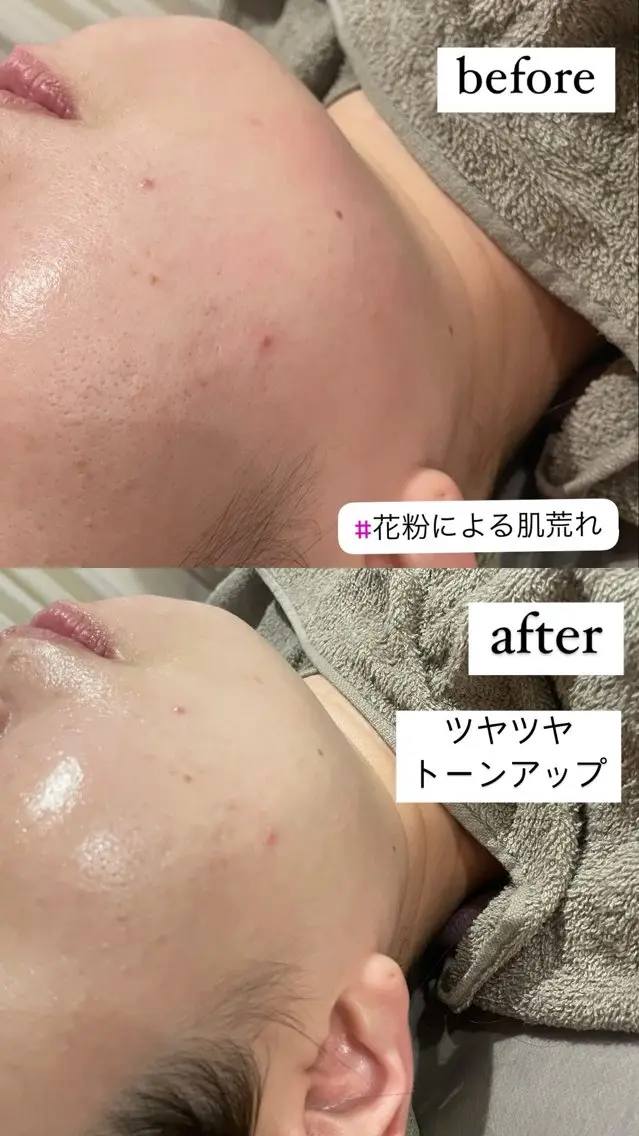 Meupニキビ専門店 背中/ハーブ/肌管理のその他イメージ