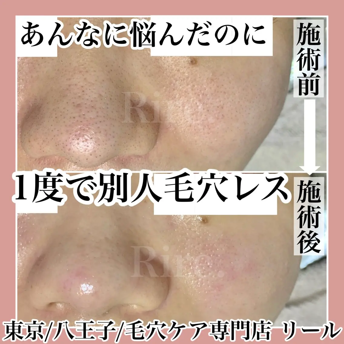毛穴特化エステ -リールのエステ・リラクイメージ