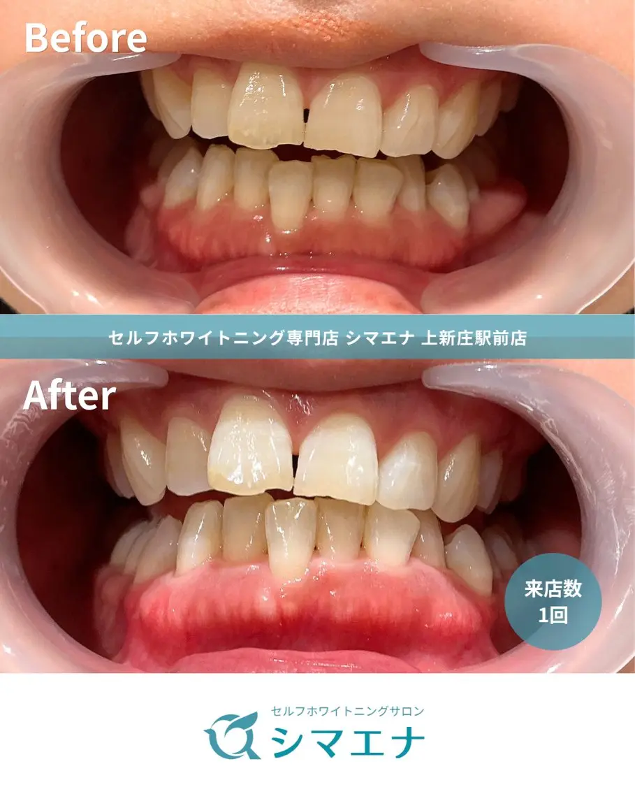 その他 セルフホワイトニング シマエナのその他イメージ