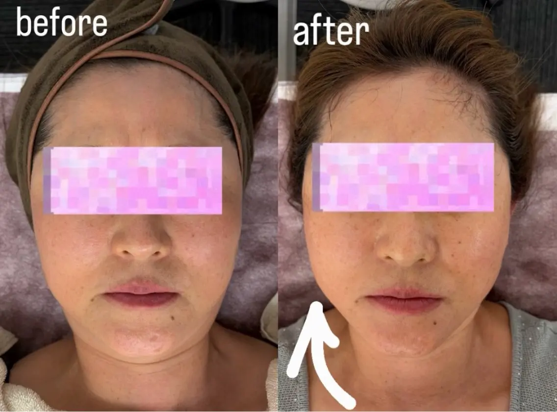 サーマトリックス(高周波)💉✨最新美容【即効小顔】DTなしで感動を◎💆♀️の写真