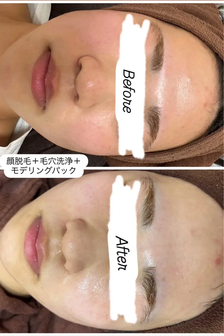 脱毛 ブリリエット 楠井のエステ・リラクイメージ