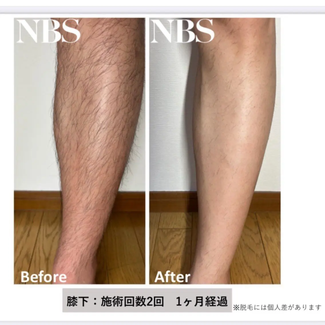 【メンズ】人気No.2✨足脱毛!!半ズボンを清潔に着こなそうの写真