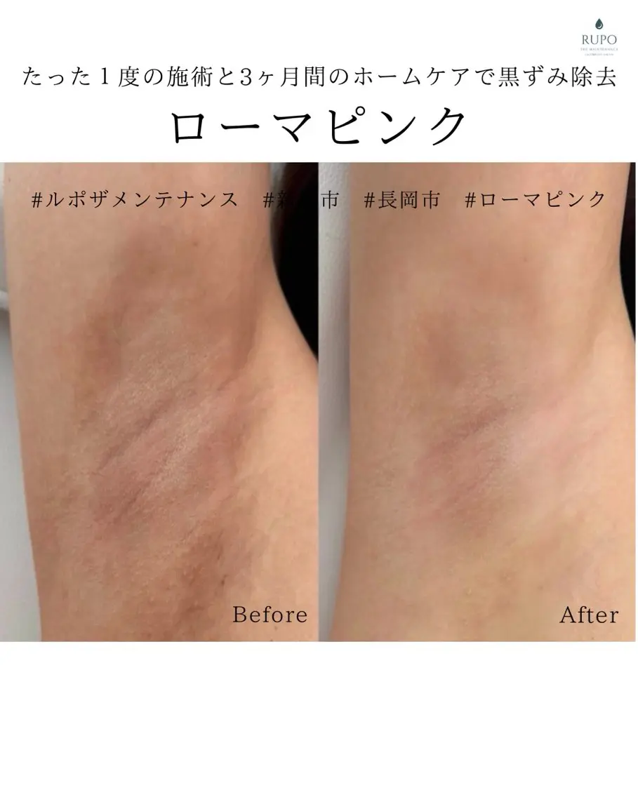 【脇orお尻下ローマピンク】カウンセリング無料当日施術可/通常259600/モニター158400の写真