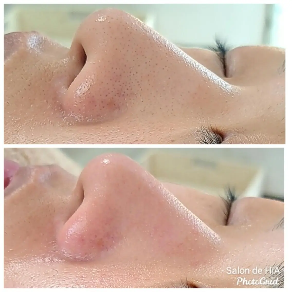 45分🕑️【毛穴】New!!✨毛穴エクストラクション👃毛穴レストリートメントの写真