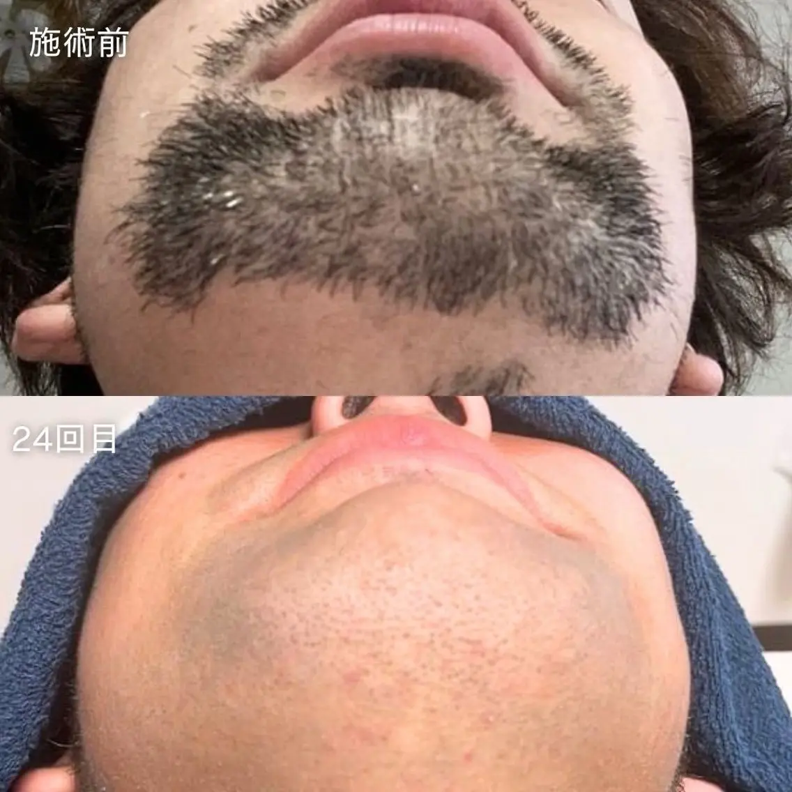 【男性】ヒゲ脱毛　初回キャンペーン価格の写真