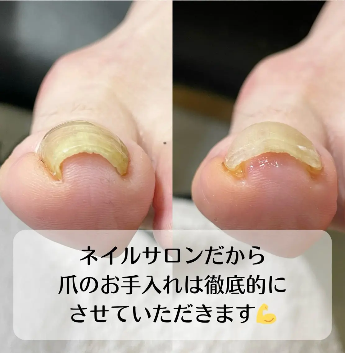 ネイル 深爪・巻き爪 専門サンセリテのネイルデザイン