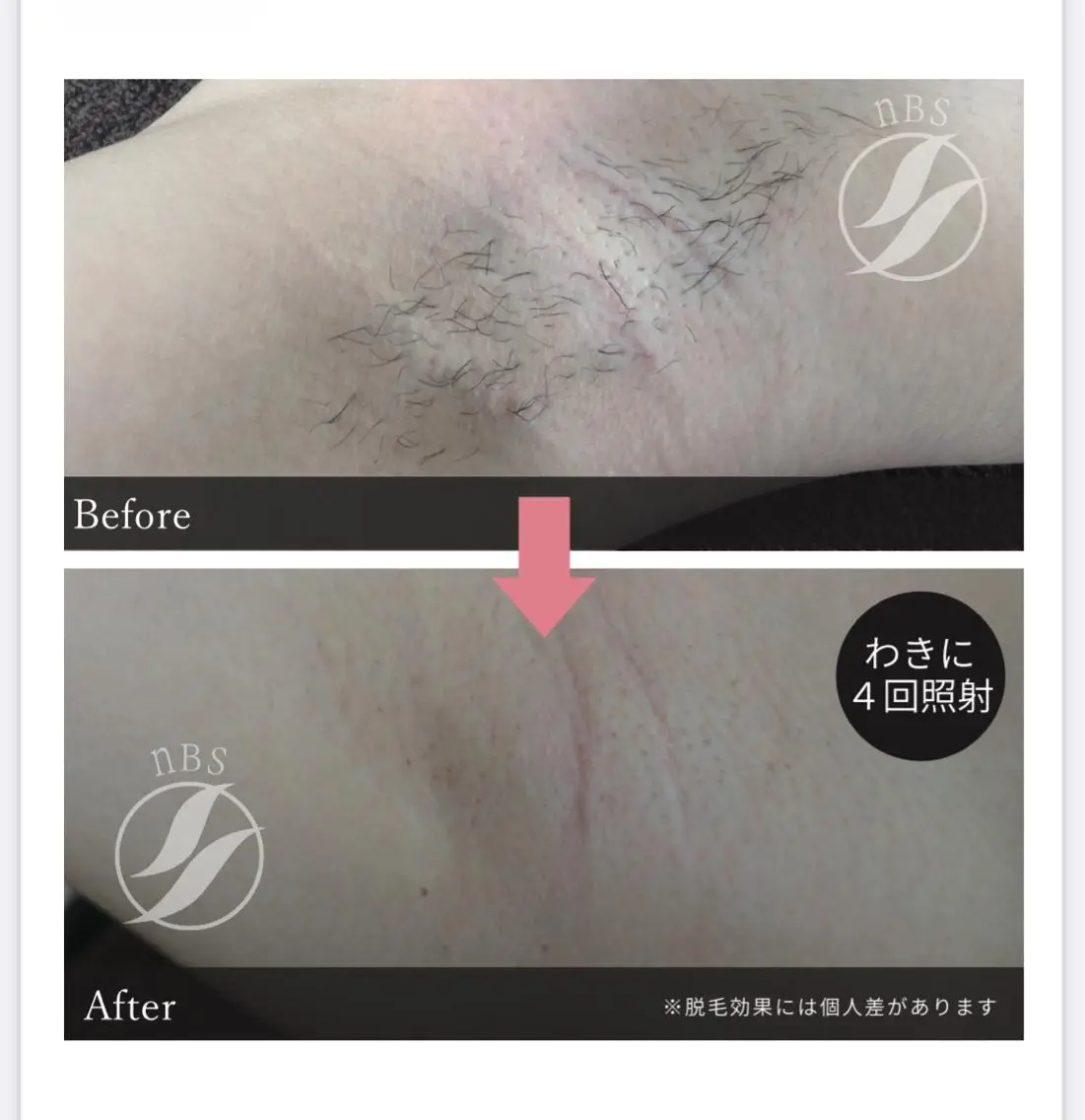 初回 THR方式 ワキ脱毛 ¥3,500→¥2,500 一度で効果が現れる人も多数…  メンズも🆗の写真