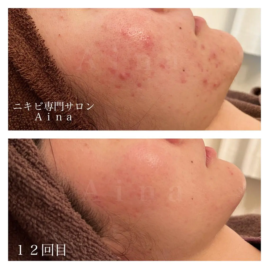 セミロング パーマ ヘアアレンジ メンズ キッズ ネイル マツエク・マツパ 赤色 エステ リラク ニキビ跡専門サロン Ainaのエステ・リラクイメージ