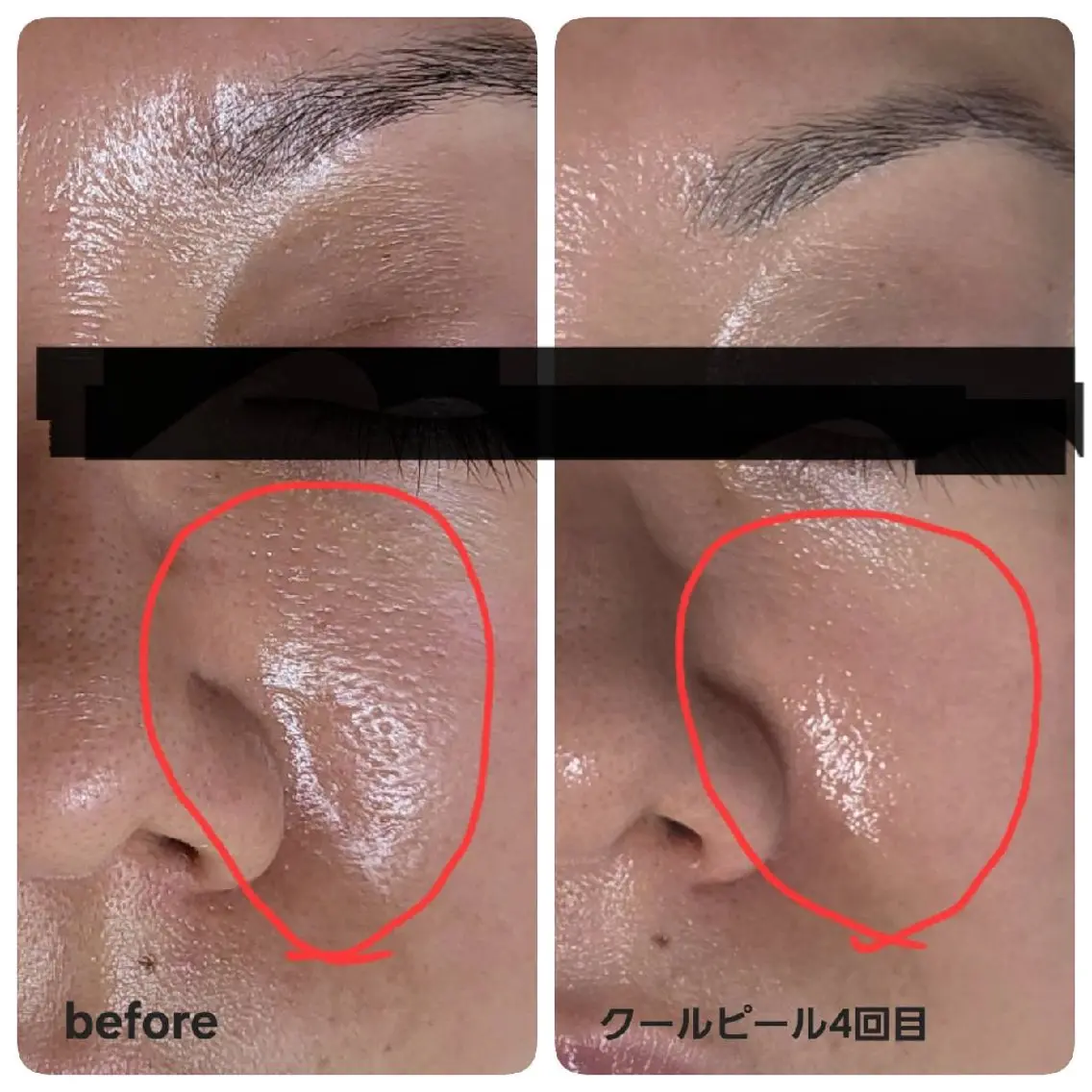 毛穴キュッ✨&トーンUPしたい方へ🔜ダウンタイムなしのピーリング+レチノール+ビタミンCイオン導入の写真