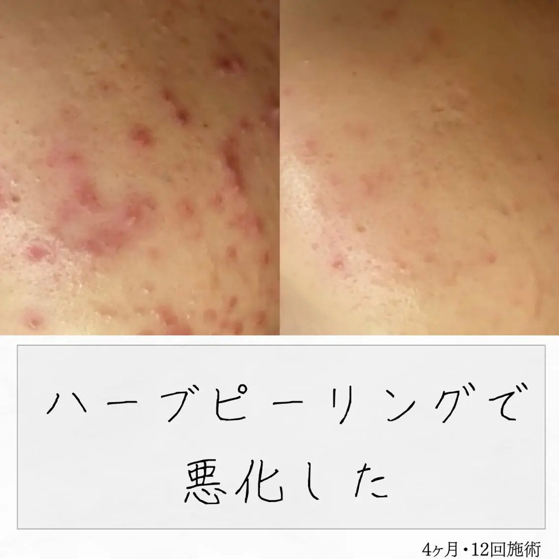 ニキビ経験者が施術 する専門サロン🌻のエステ・リラクイメージ