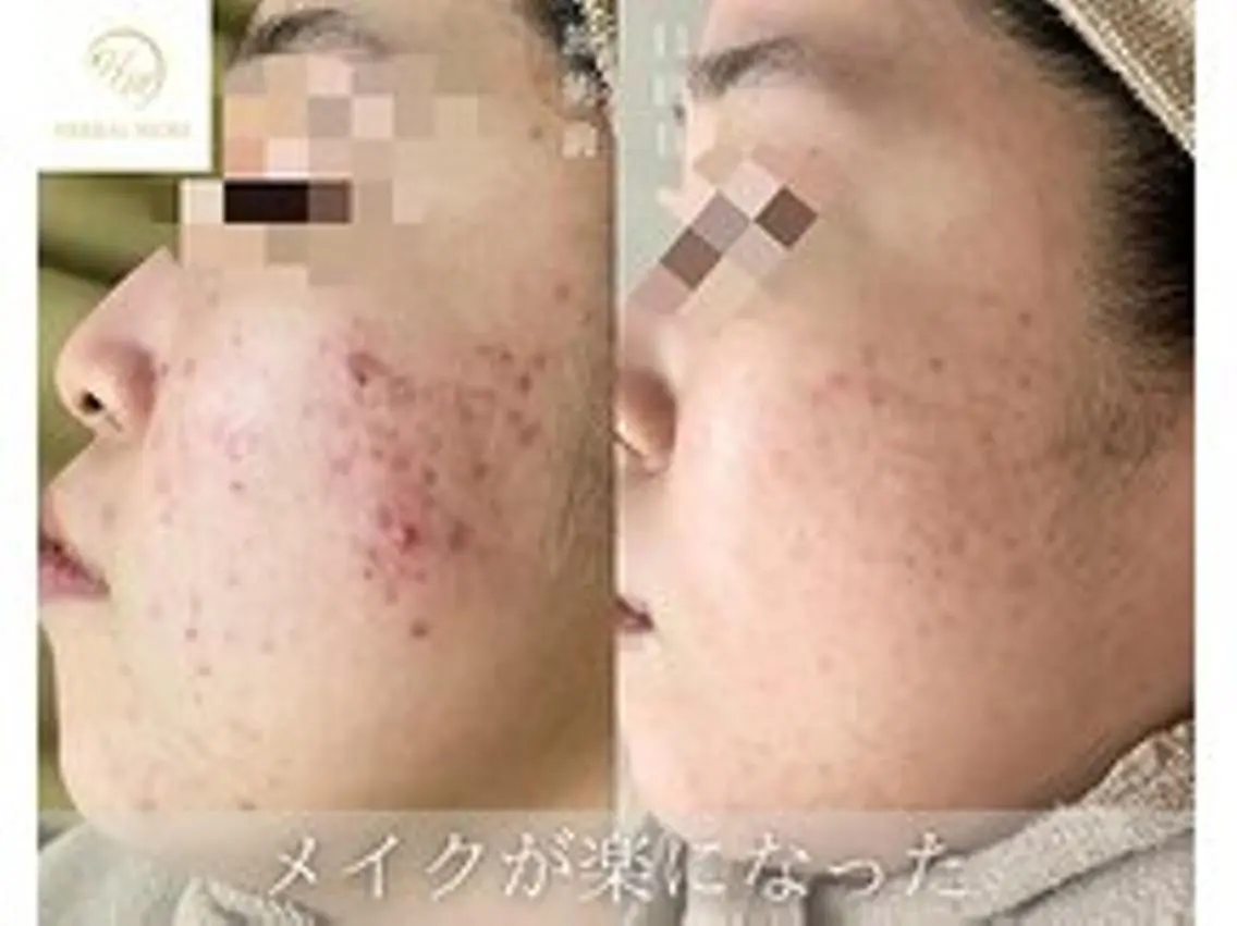 人気No.1【ニキビ/凸凹肌が気になる方】剥けるハーブピーリング＋鎮静パックの写真