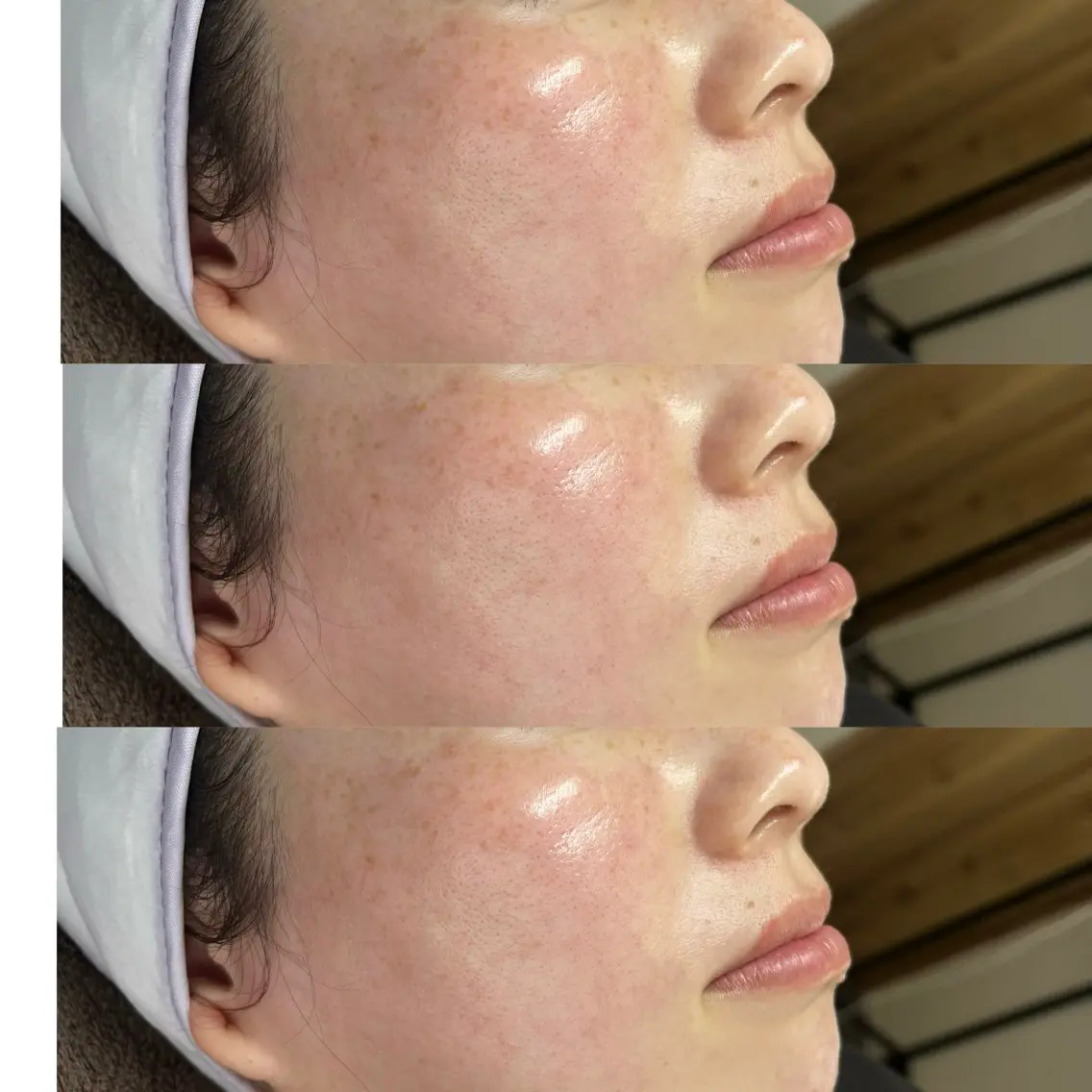 フェイシャルワックス脱毛の写真