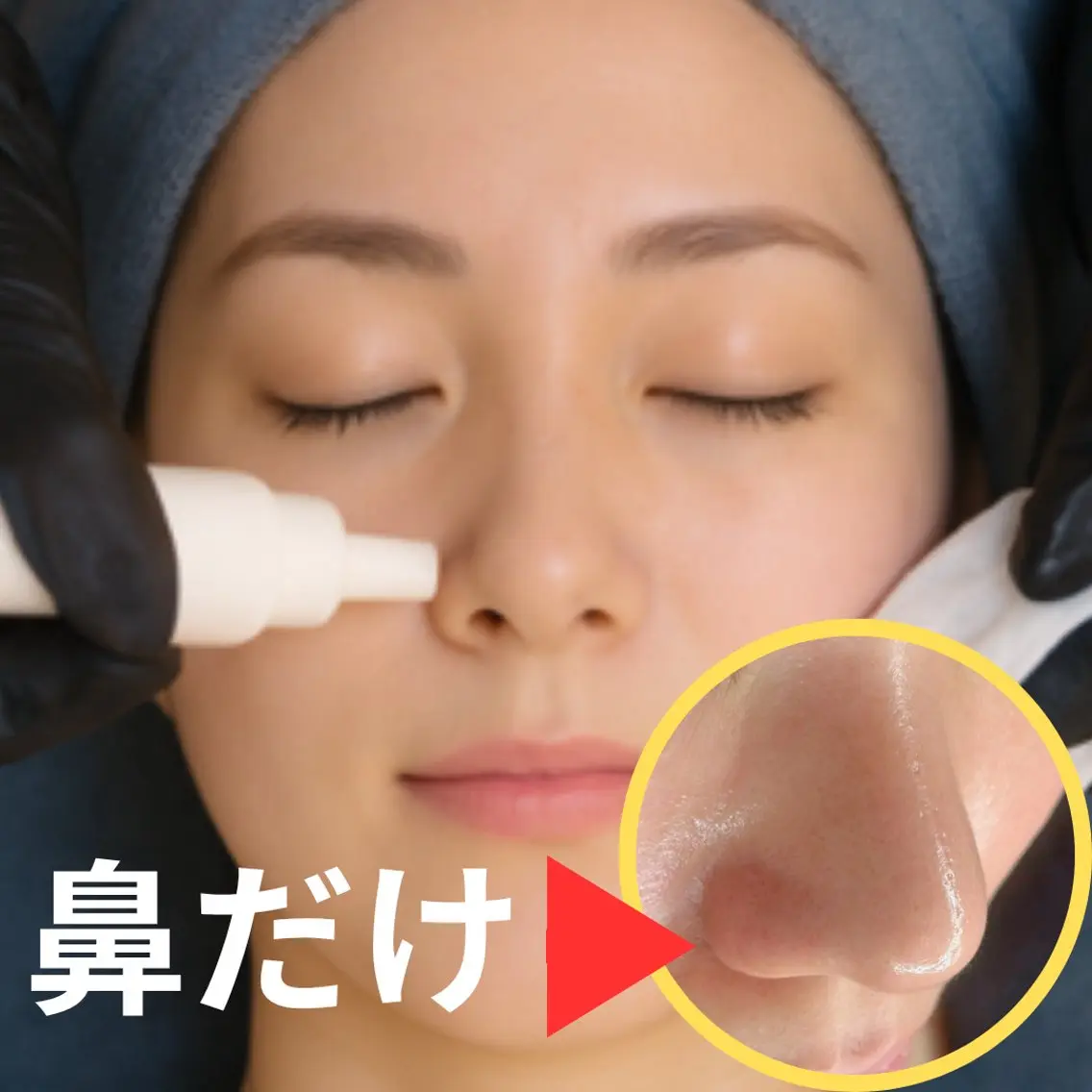 【鼻だけ割】鼻毛穴洗浄 × 高濃度ビタミンC浸透ケアの写真