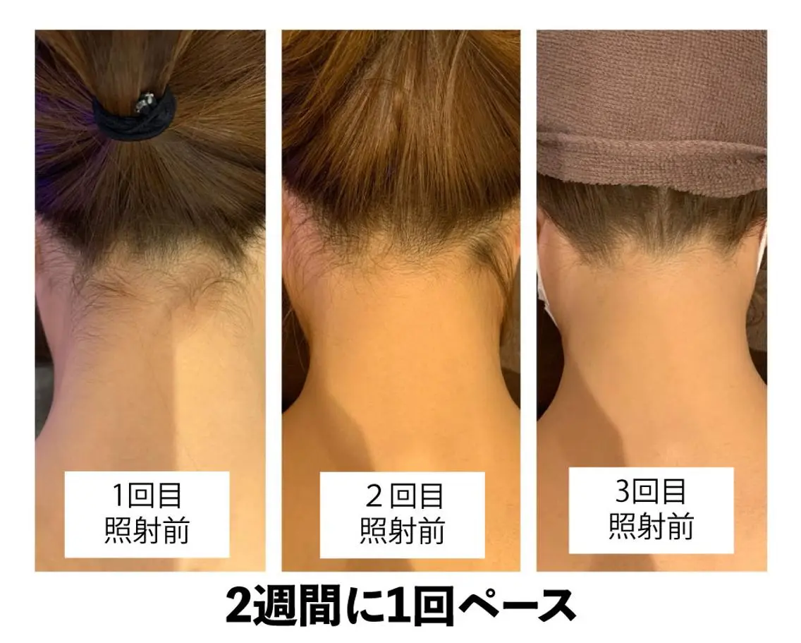 🎀うなじ脱毛🎀 ㅣLino堀江のエステ・リラクイメージ