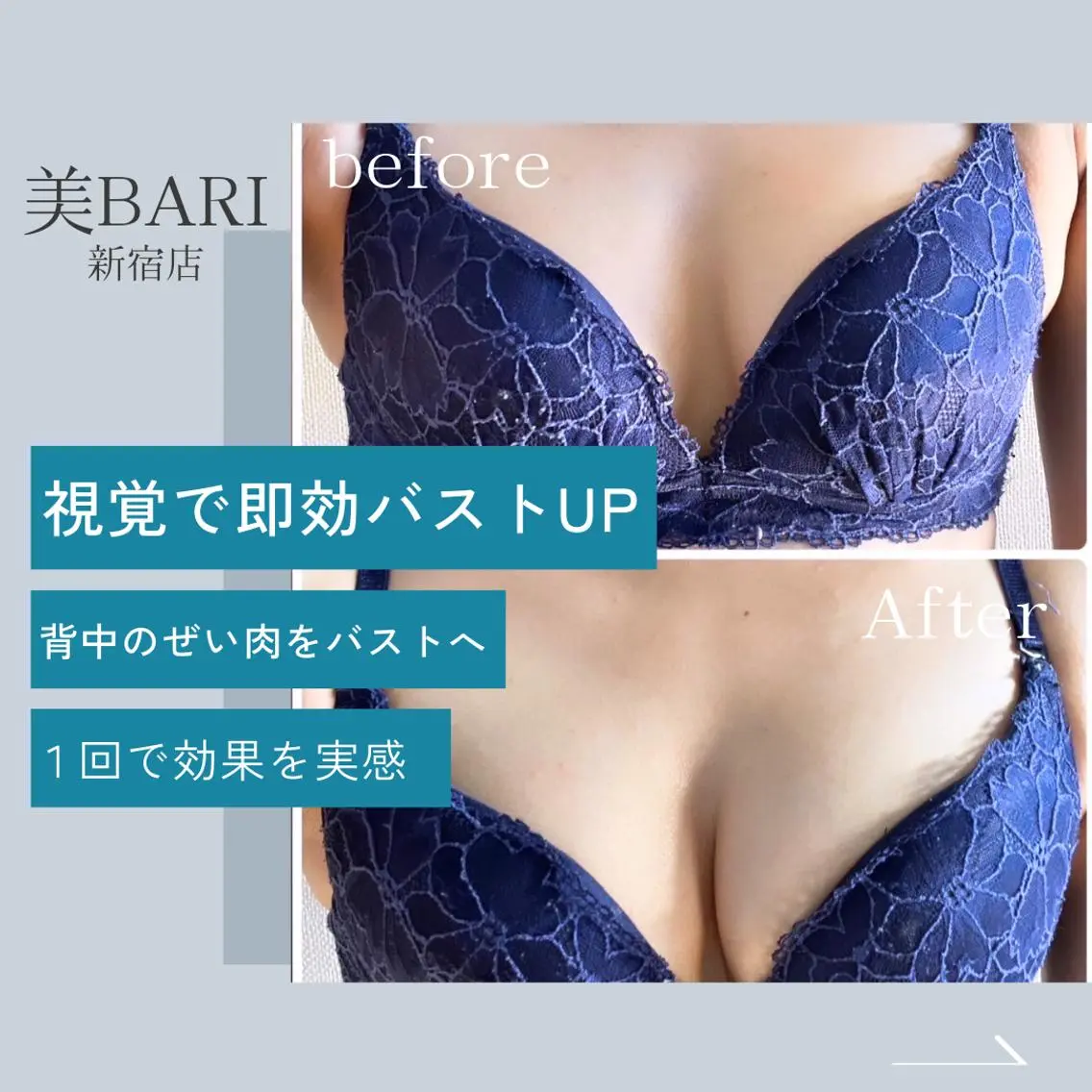 【デコルテケア/クリニック施術の術後ケアに◎】🎀バストup&ケア施術🎀背中に流れてしまったお胸をバストに◎の写真