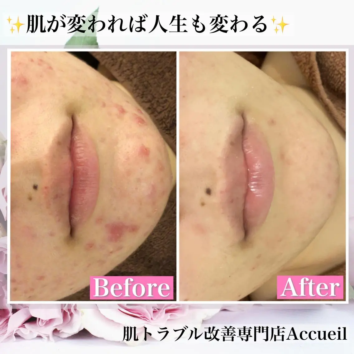 ショート カラー パーマ ヘアアレンジ メンズ キッズ ネイル マツエク・マツパ アイブロウ ニキビ・肌質改善専門 ♡人生が変わるサロンのエステ・リラクイメージ
