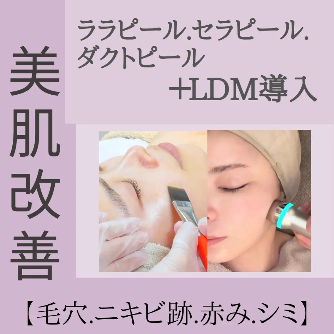 【毛穴レス&赤みくすみ集中ケア】セラ💜orララ💛orダクト💙ピール×LDM◇つるんと水光美肌の写真