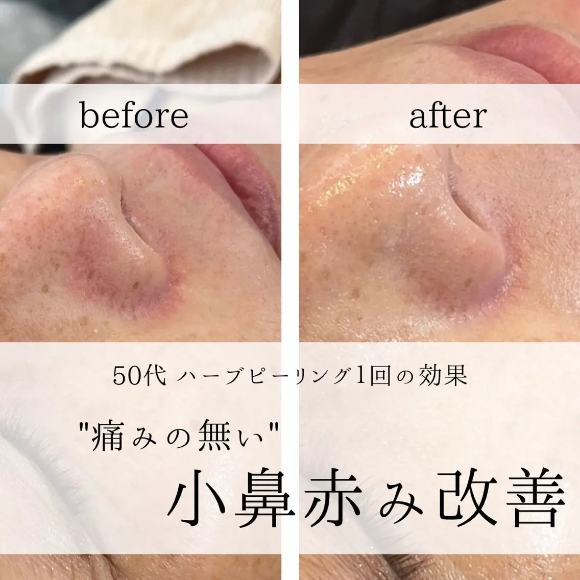 yc.hacci 【ハーブピーリング】の眉毛・アイブロウイメージ
