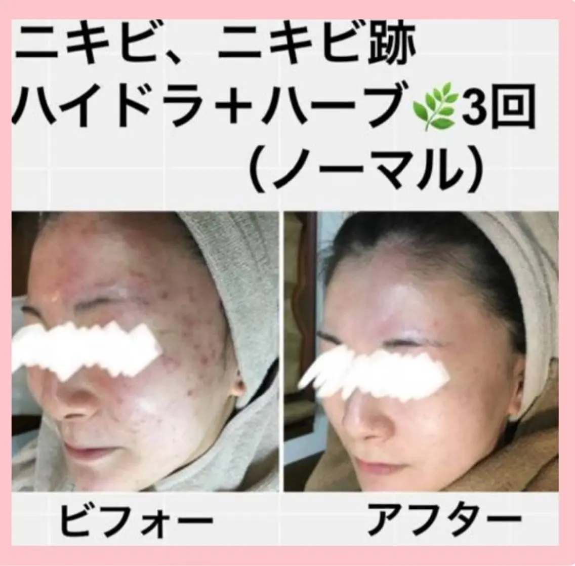 🌿ハーブピーリングソフト＆毛穴洗浄、角質除去、美容保湿🌿吹き出物、吹き出物跡、毛穴、美白、黒ずみ、赤み等に🩷の写真