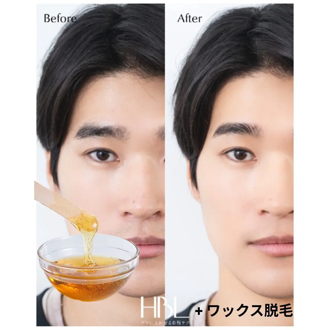 【初回/男性限定】HBL + ワックス脱毛Miniの写真