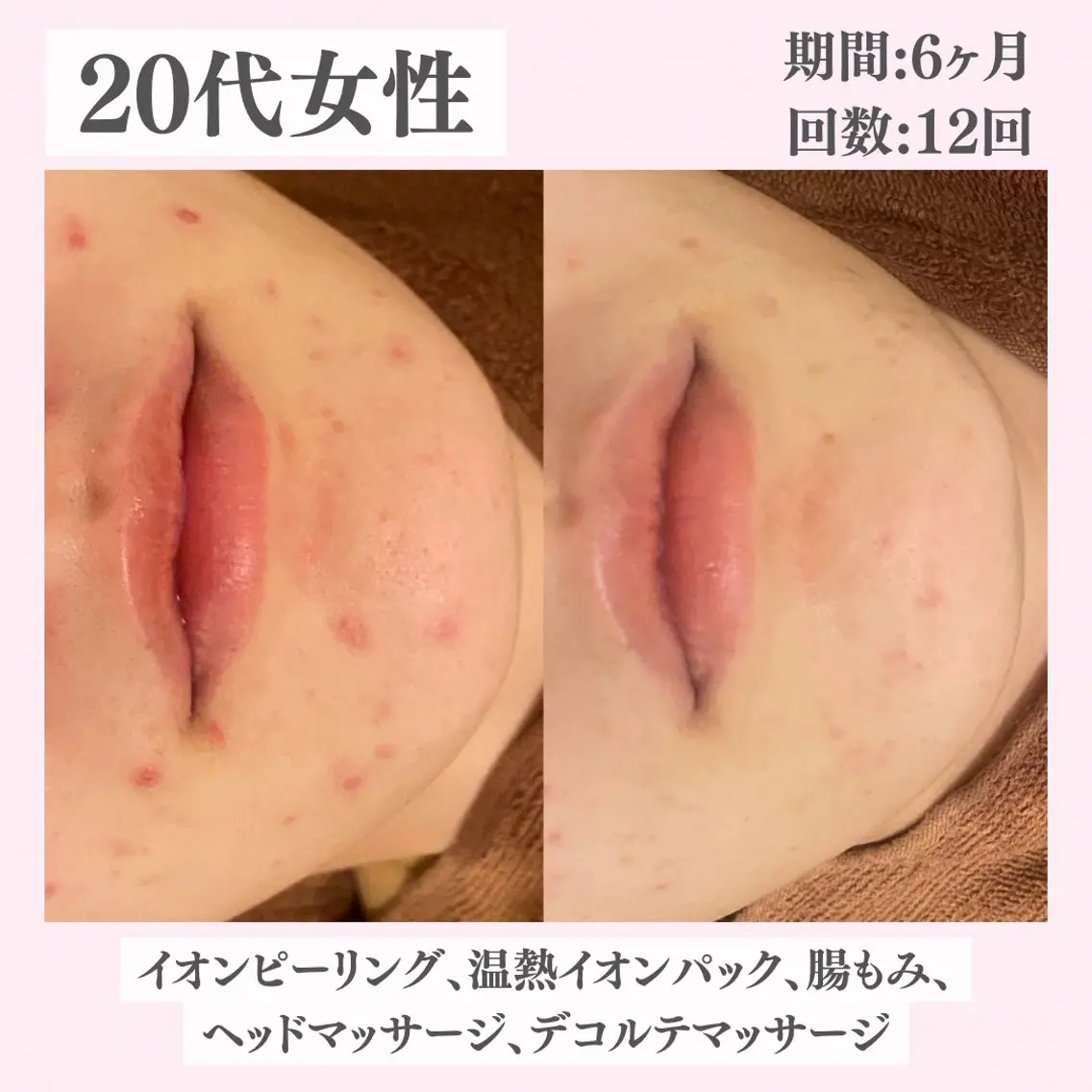 エステ リラク ニキビ・肌質改善専門 ♡人生が変わるサロンのエステ・リラクイメージ