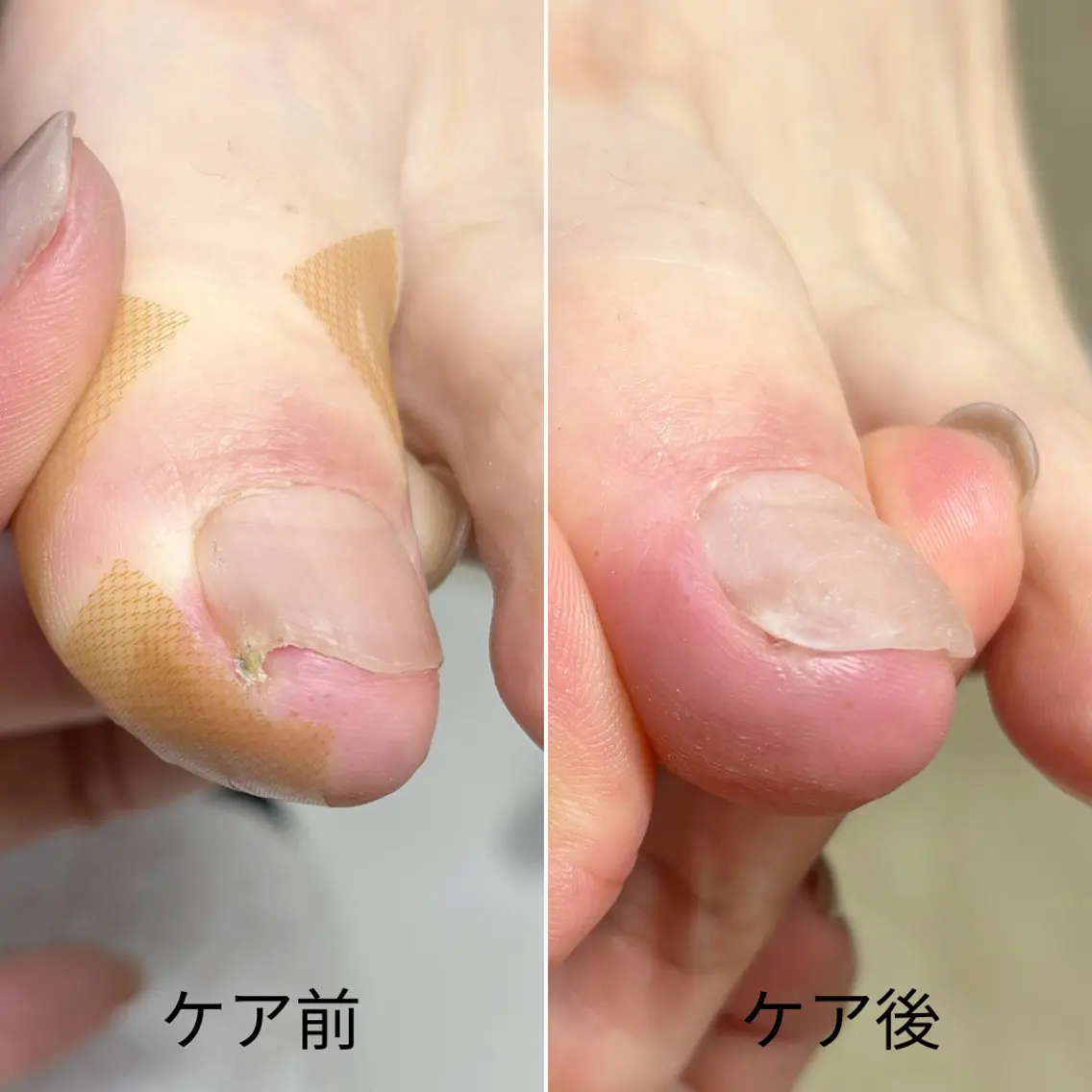 ネイル 巻き爪・肥厚爪ケア 専門サンセリテのネイルデザイン