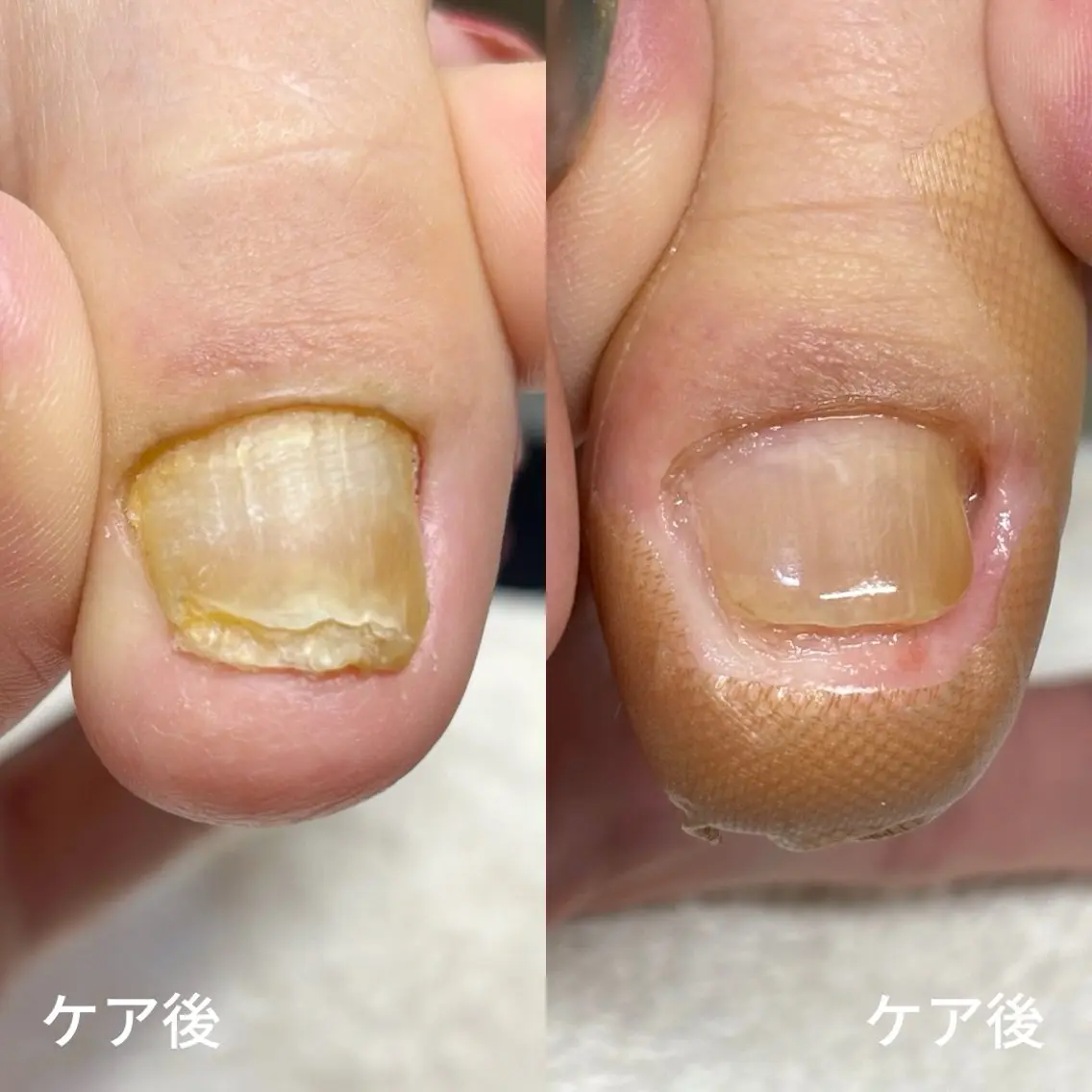 ネイル 巻き爪・肥厚爪ケア 専門サンセリテのネイルデザイン