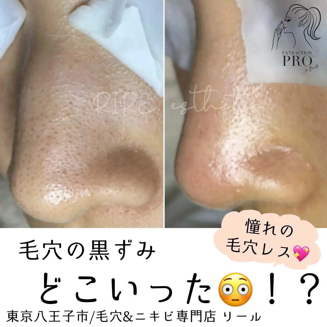 毛穴特化エステ -リールのエステ・リラクイメージ