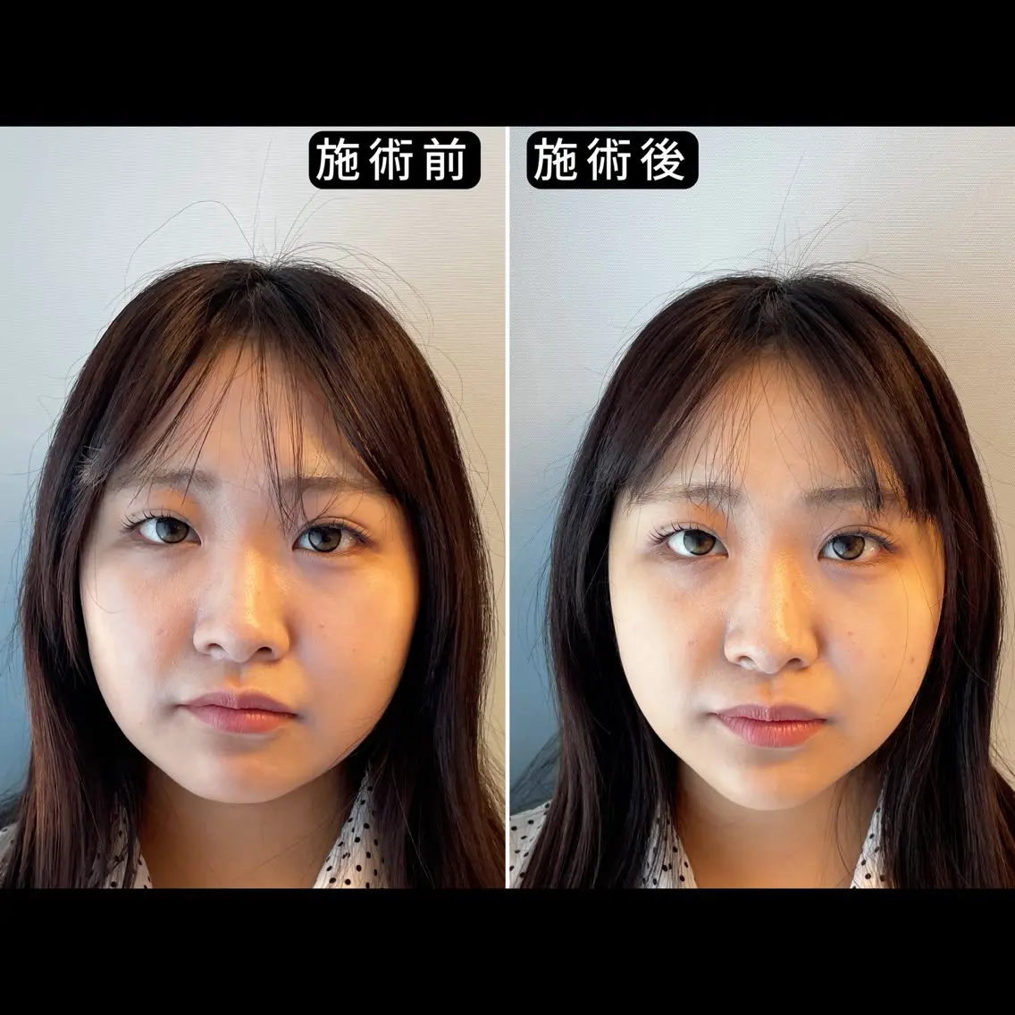 エステ リラク 渋谷 小顔美容鍼 専門サロン YZのその他イメージ
