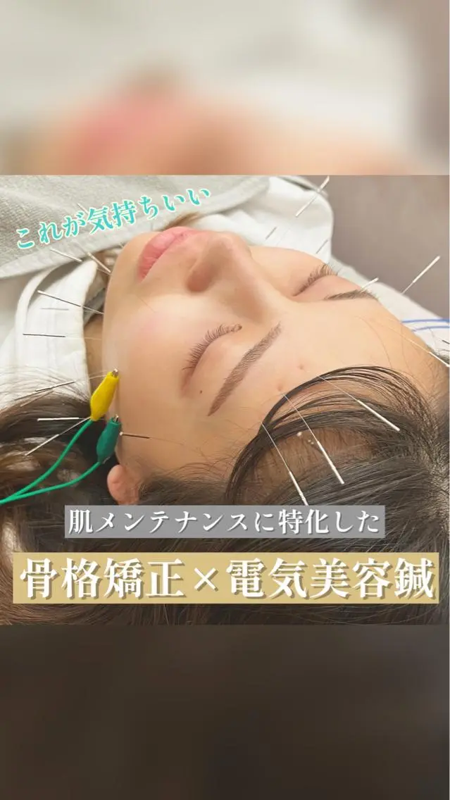【劇的変化！】むくみ撃退美容鍼✨の写真