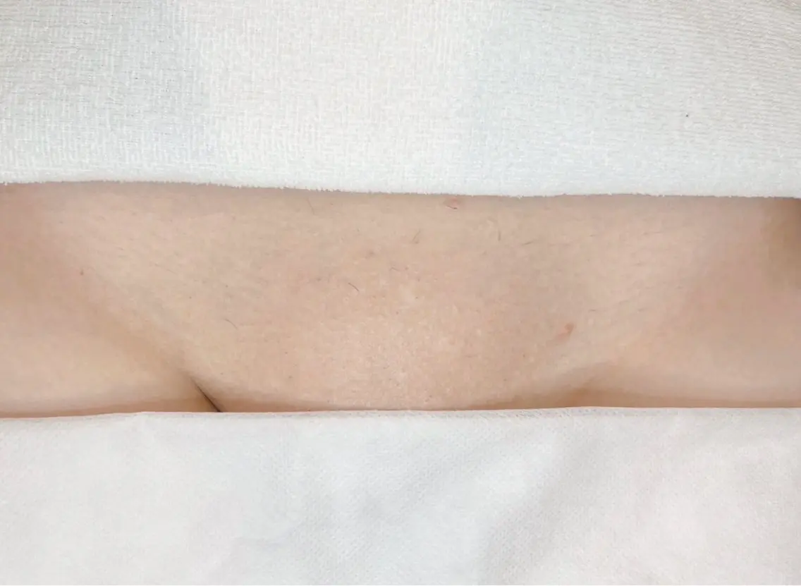 VIOのワックス脱毛。オールオフ/V残してIOオフ、どちらでもOK!の写真