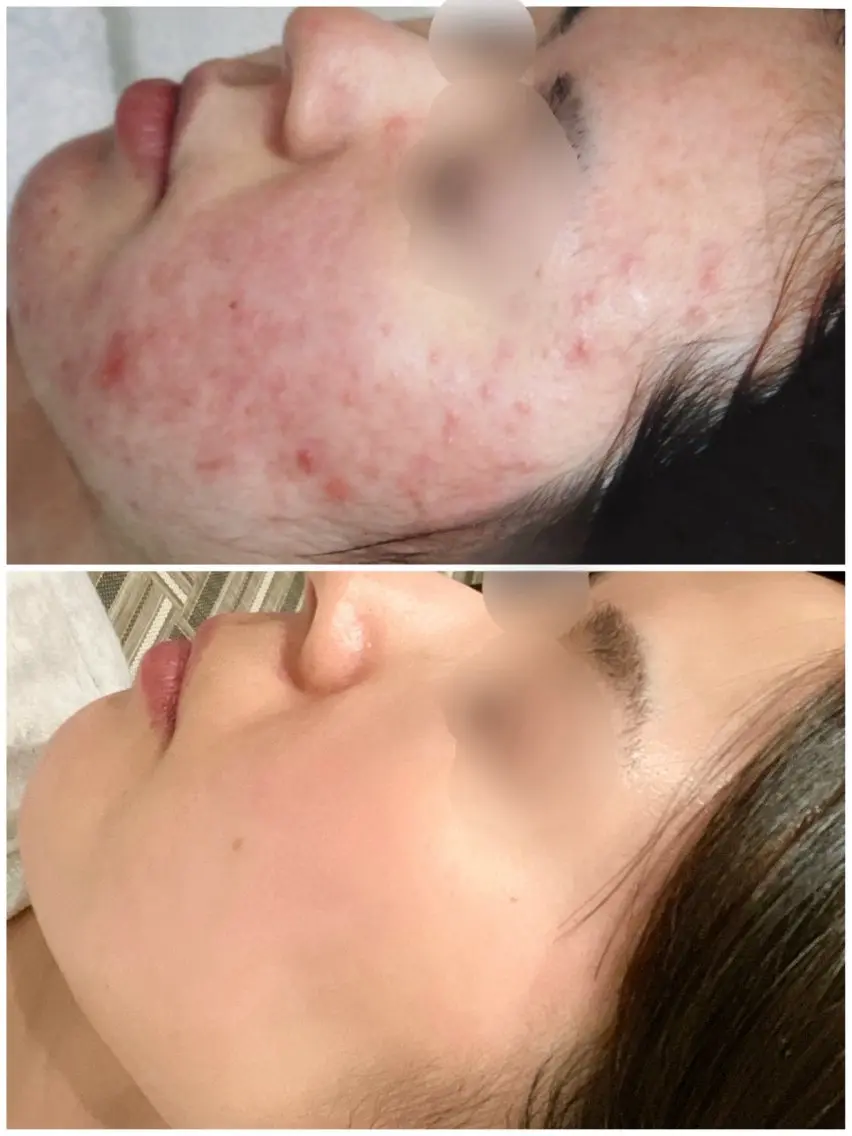 【TIPハーブピーリング】剥離なし・ダウンタイムなし✨やさしく整える肌ケアの写真