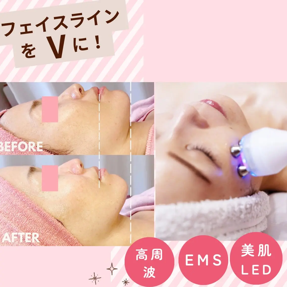 【小顔リフトアップ】モニター VリフトUP&弾力UP★特殊電流で美容液導入と筋肉刺激 ★小顔効果リンパマッサージ付の写真