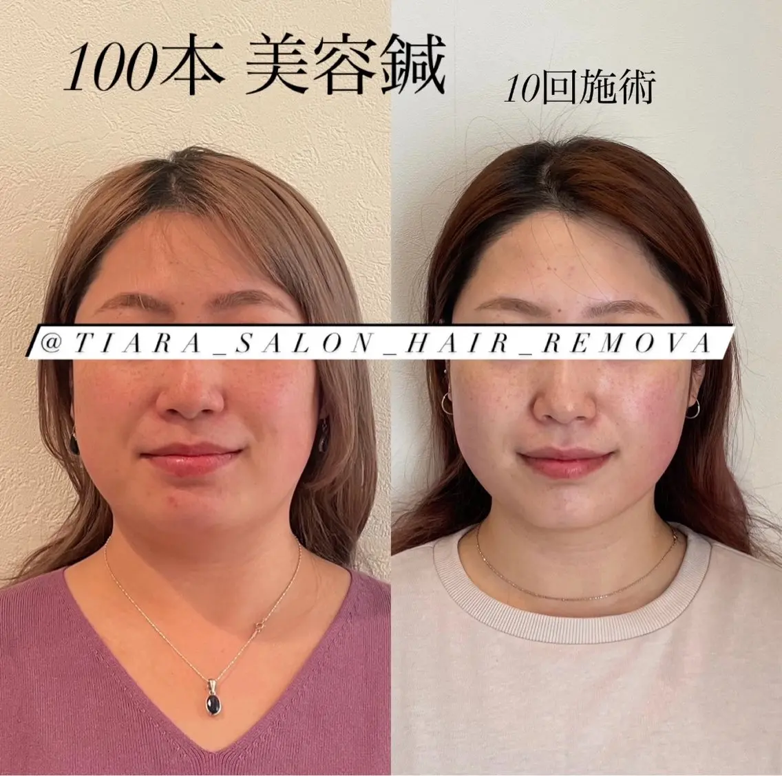 鍼灸サロン TIARA　美容鍼のエステ・リラクイメージ