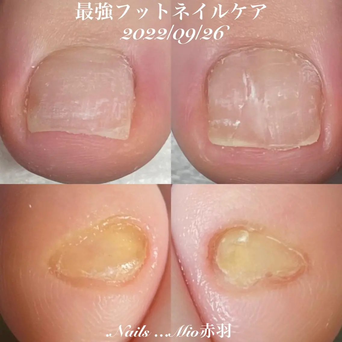 👣痛みが取れる巻爪親指&小指ケア4本60分の写真