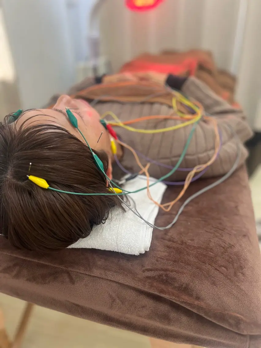 電気を流す美容鍼（初回5,500円）の写真