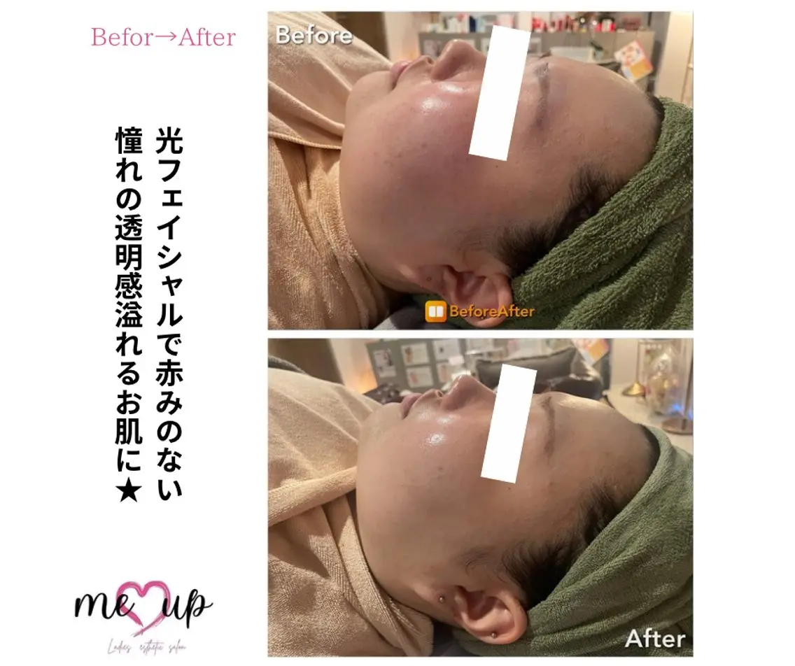 エステ Meupニキビ専門店 背中/ハーブ/肌管理のその他イメージ