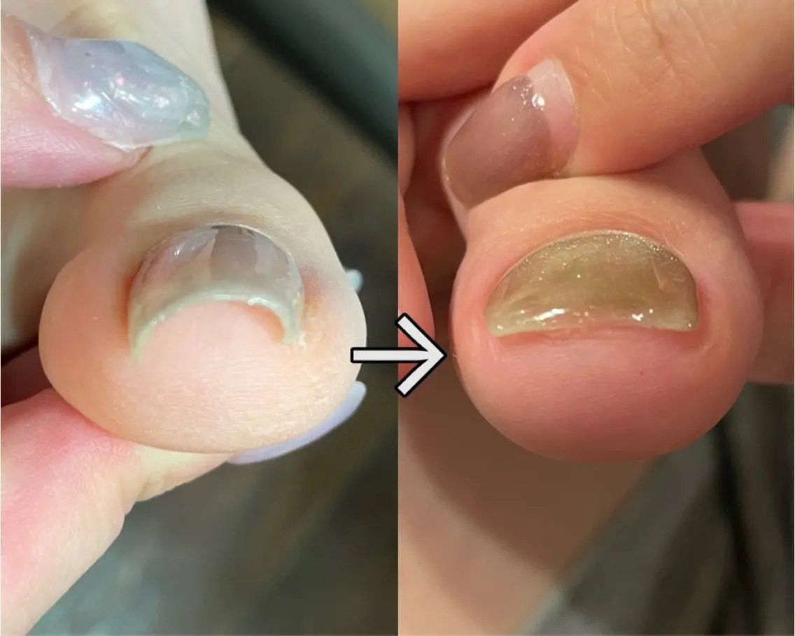 フット巻き爪プレート込みジェルネイルの写真